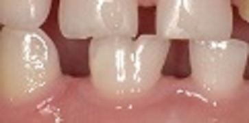 乳歯の癒合歯