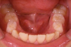 子供の歯並びの予防19 頬杖は絶対ダメ 歯並びが悪くなるだけ 仙台市泉区 富谷市のただ歯科クリニック