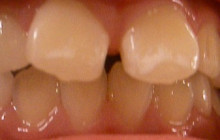 虫歯予防1 生えてきた大人の歯が白くなっている これって虫歯 仙台市泉区 富谷市のただ歯科クリニック