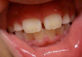 前歯の隙間