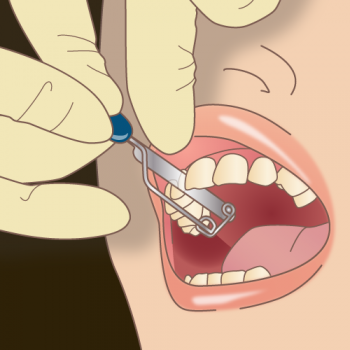 歯の形態修正でスペースを作る