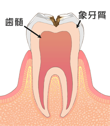 大きく広がった虫歯