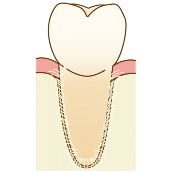 歯根膜は歯と骨のクッション