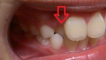 側切歯のクロスバイト