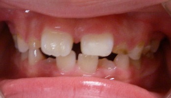 前歯の隙間を閉じるタイミング