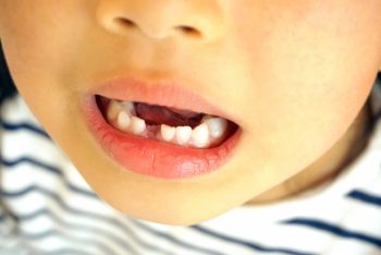 歯がグラグラしているときは矯正治療がしやすいのでしょうか？