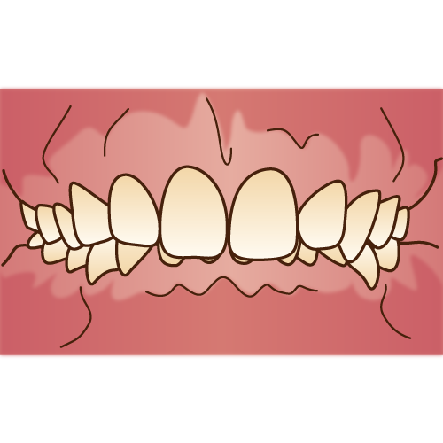 子供の歯並び13 乳歯の深いかみ合わせ 過蓋咬合 にご注意ください 仙台市泉区 富谷市のただ歯科クリニック