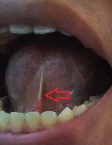 舌小帯
