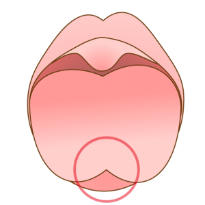 舌小帯に問題がある子供のあっかんべー